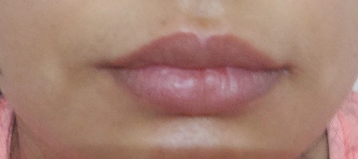 Best Lip Rejuvenation Treatment in Gurgaon