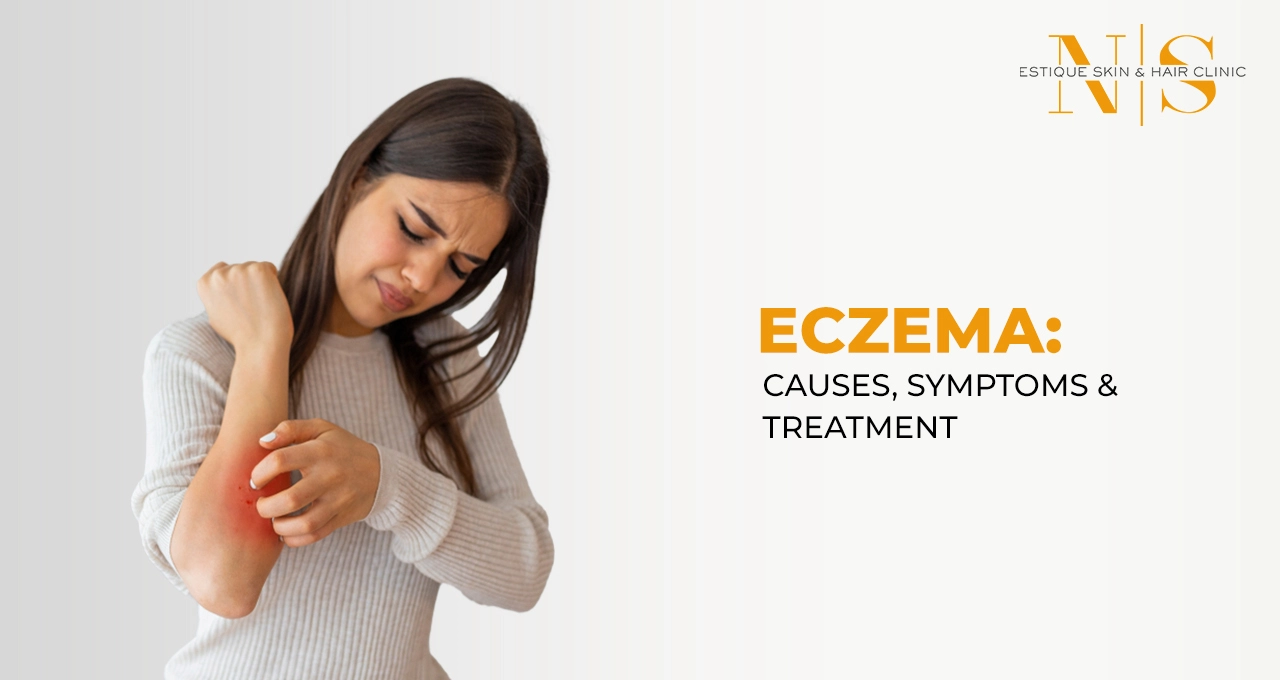 Eczema: Causes, Symptoms & Treatment