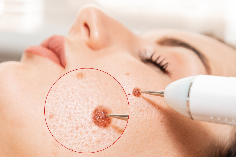 Best Moles Removal Treatment in Gurgaon