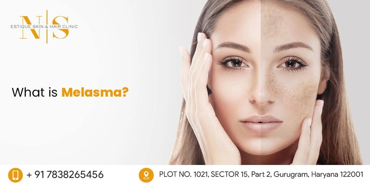 Melasma Treatment