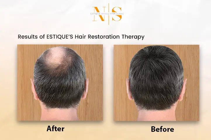 Hair Restoration Video