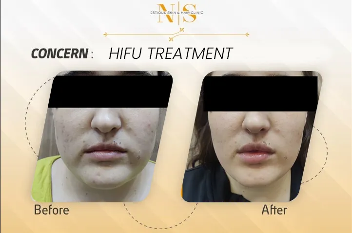 Before and after result 2