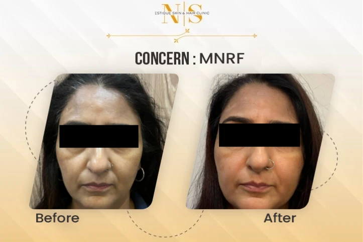 Before and after result 3