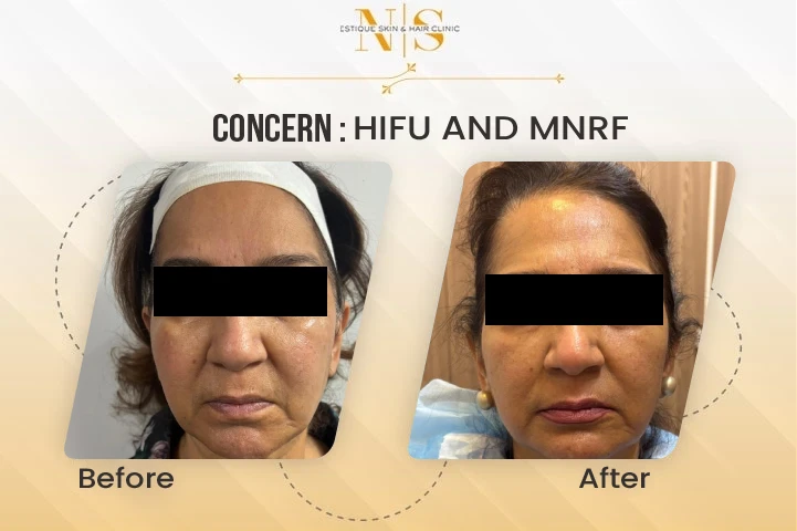 Before and after result 5