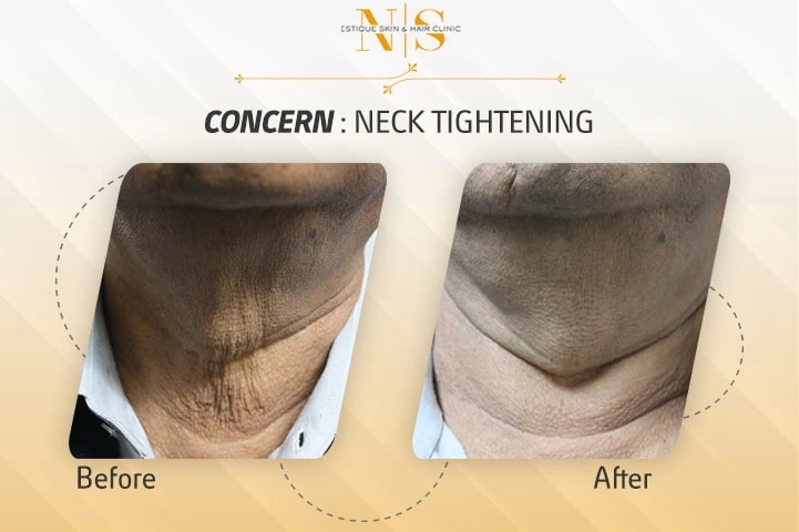 Before and after result 6