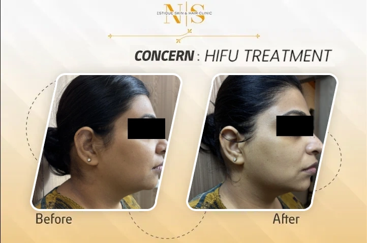 Before and after result 6