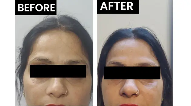 Fillers Treatment in Gurgaon