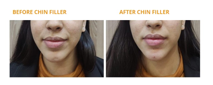 Fillers Treatment in Gurgaon