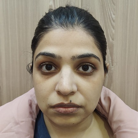 Fillers Treatment in Gurgaon