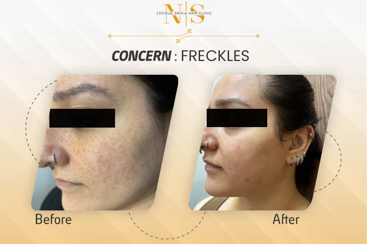 before-and-after-freckles-2