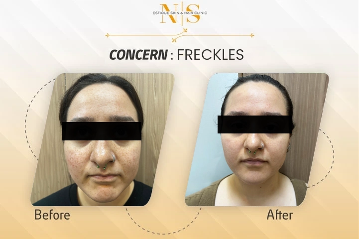 Freckles Before and After