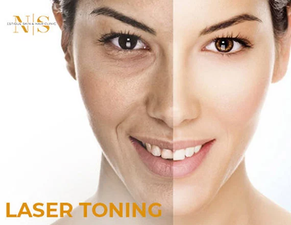 LASER TONING