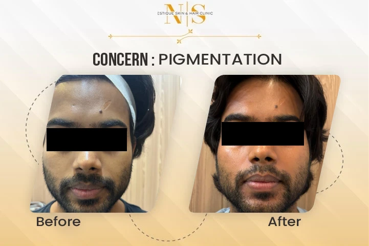 pigmentation before after