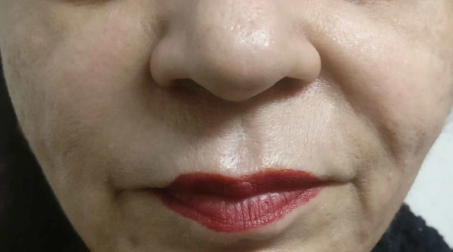 Before Cheek Fillers