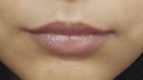 Before Lip Fillers