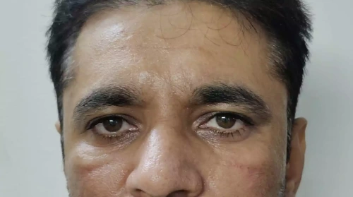 Before Under Eye Rejuvenation