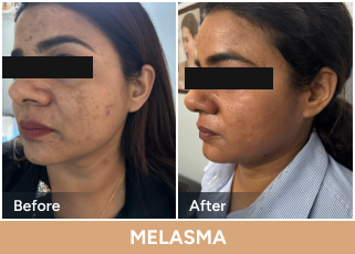 Melasma