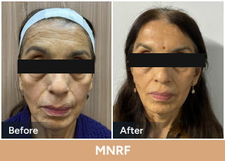 MNRF