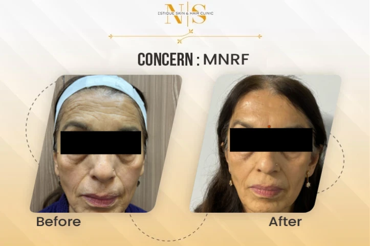 Skin Booster Before & After Image 2