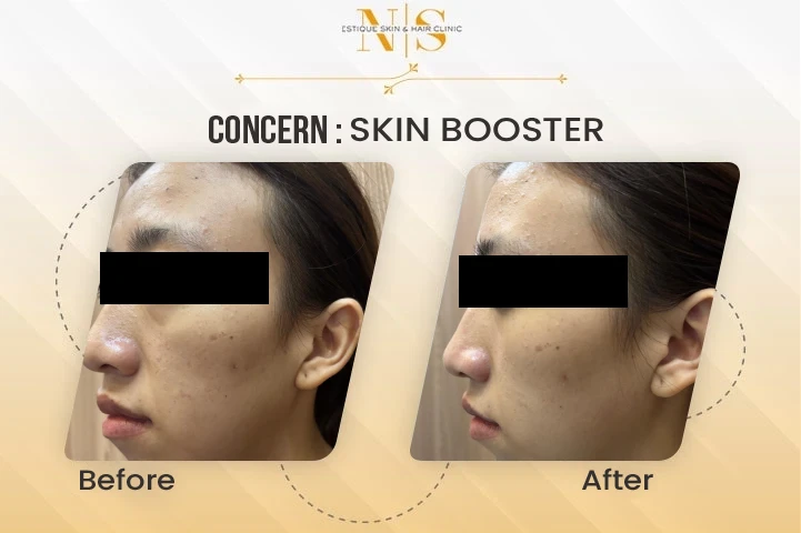 Skin Booster Before After Image