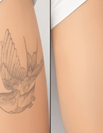 Tattoo Removal After