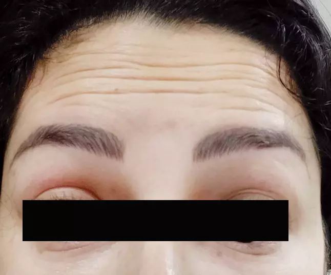 Anti Wrinkle Injections before