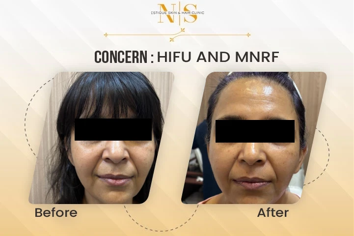 hifu and mnrf before after new