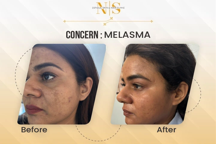 melasma before and after