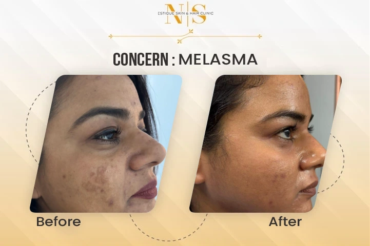 melasma before and after