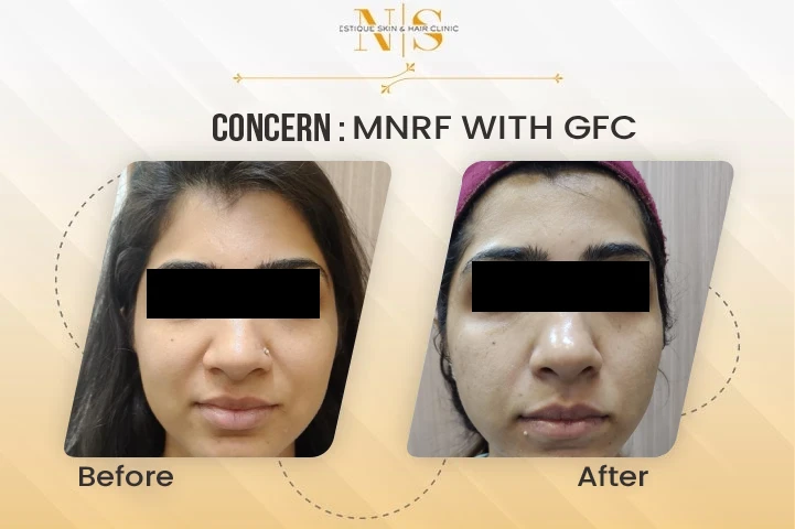 mnrf with gfc before after