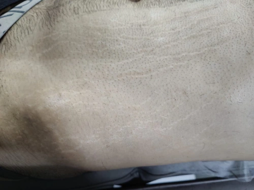 stretch mark before